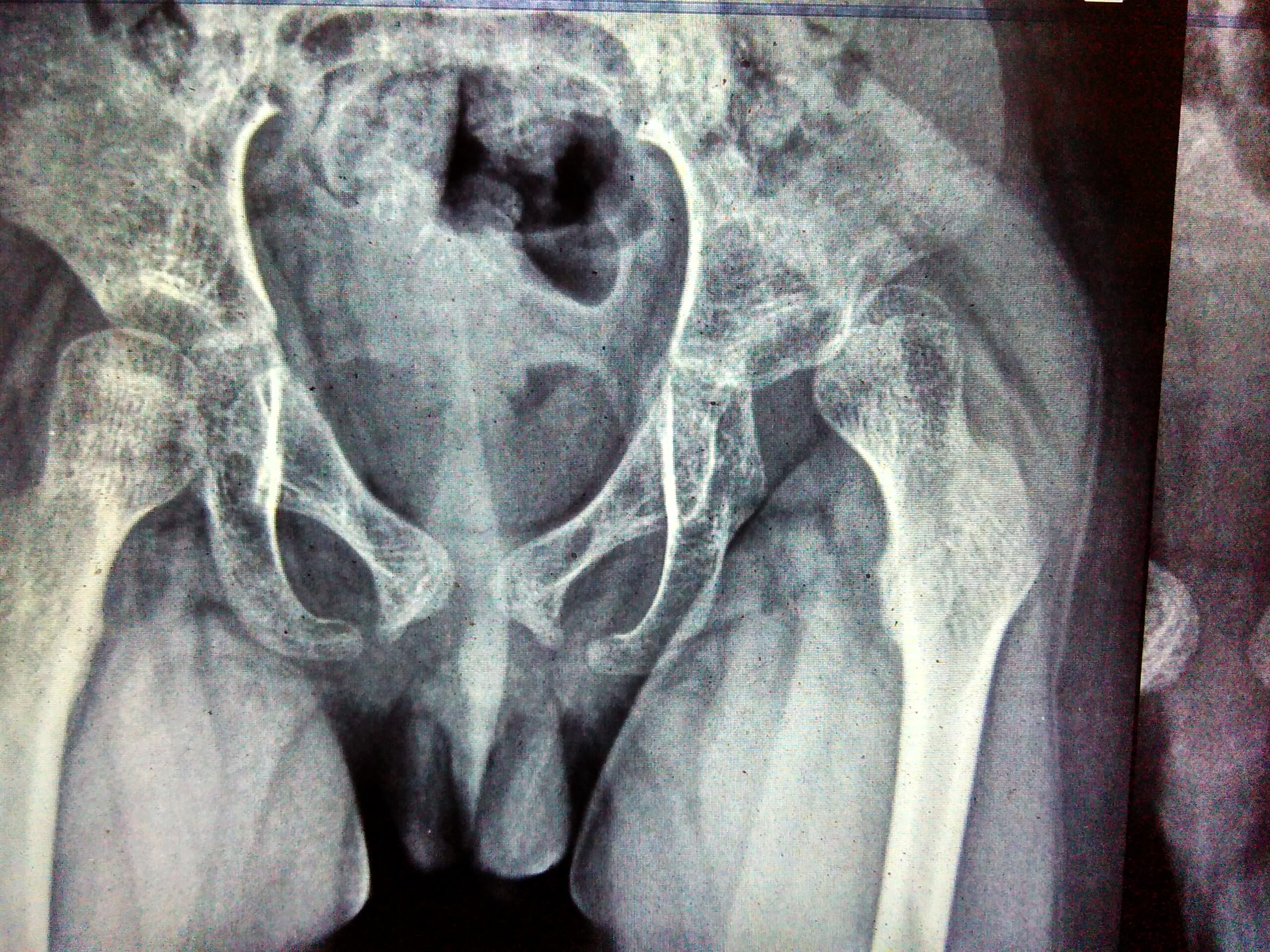 Nisarga’s hip is dislocated